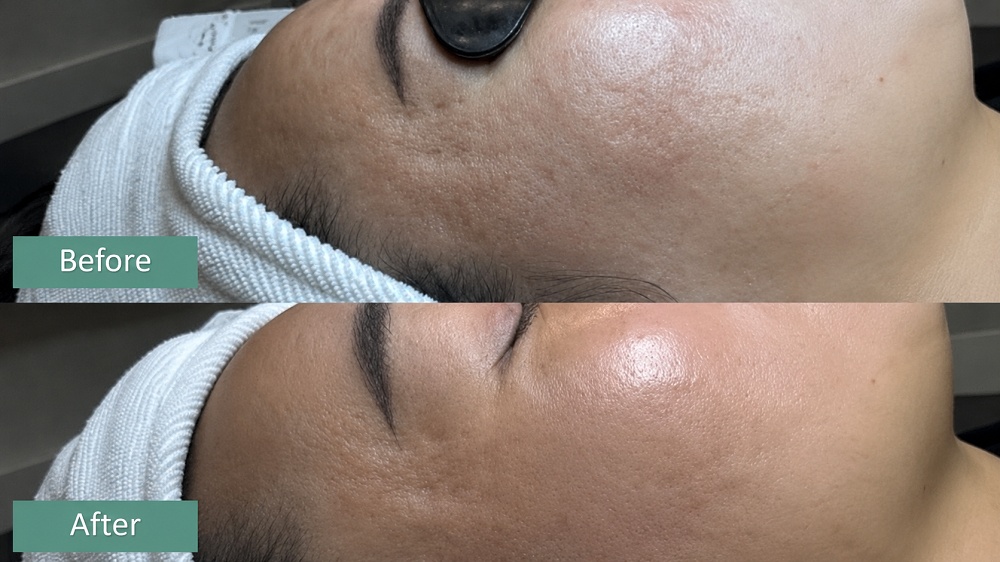 chemical peels before after skin transformation results plano texas service