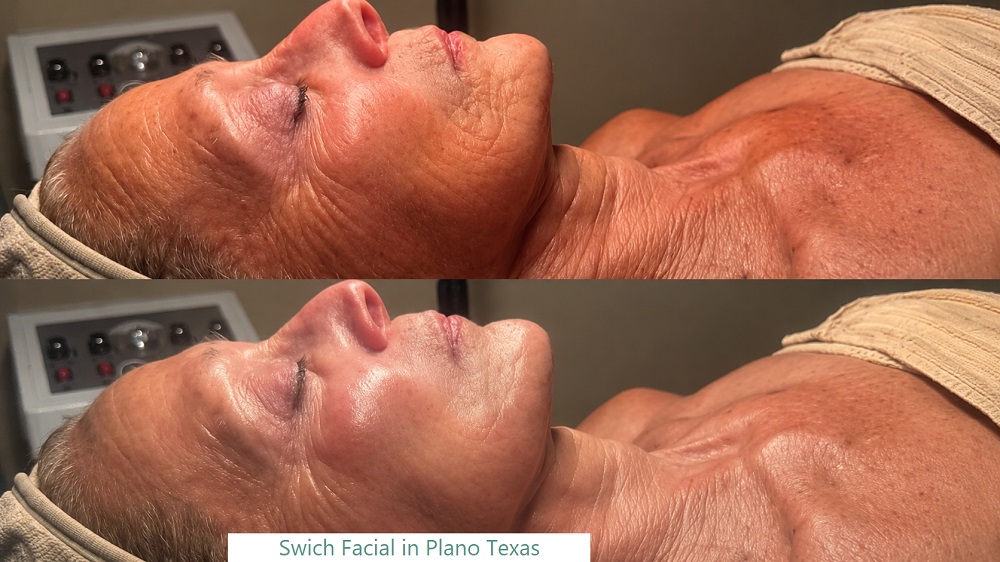 switch facial plano texas