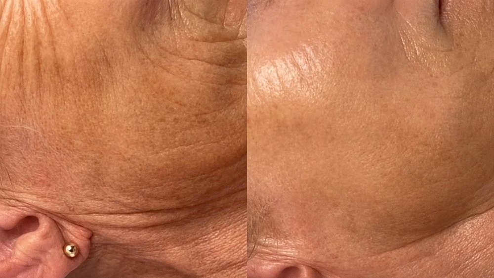 switch facial plano texas