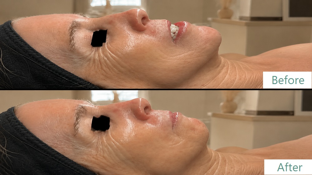 switch facial acne scar
